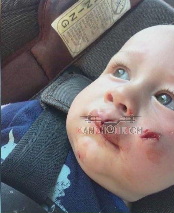 美国爱荷华州一岁孩童被无人机打伤脸部
